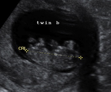 Name:  twinb.jpg
Views: 128
Size:  29.5 KB