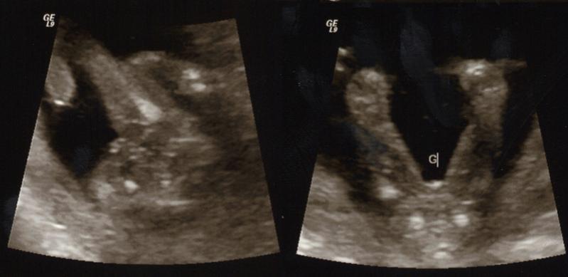 Name:  17 week gender smaller.jpg
Views: 439
Size:  28.5 KB