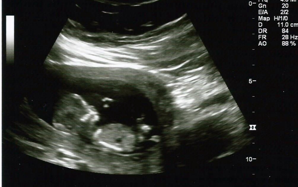 Name:  12 week sonogram.jpg
Views: 797
Size:  197.9 KB