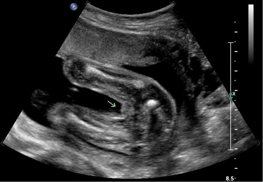 Name:  baby_gender_guess.jpg
Views: 1109
Size:  85.7 KB