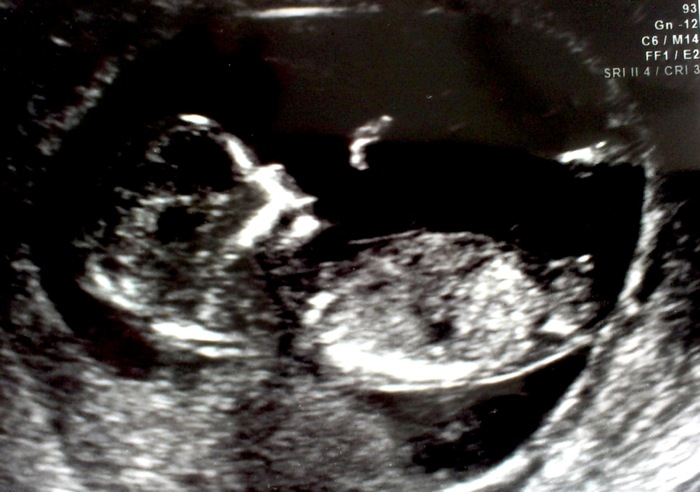 Name:  12.5 wk ultrasound.jpg
Views: 221
Size:  93.7 KB
