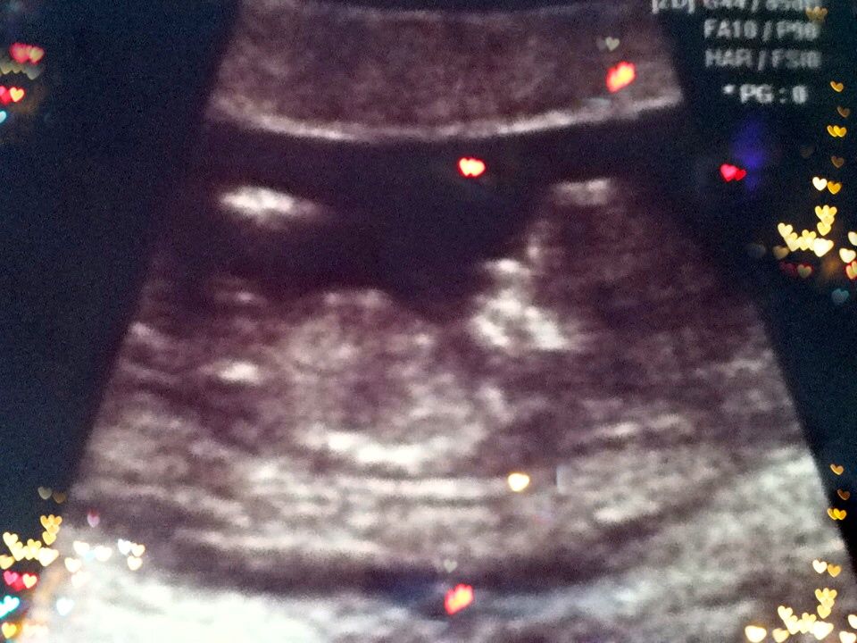 Name:  12w+3d Ultrasound w: Baby#2.jpg
Views: 284
Size:  120.6 KB