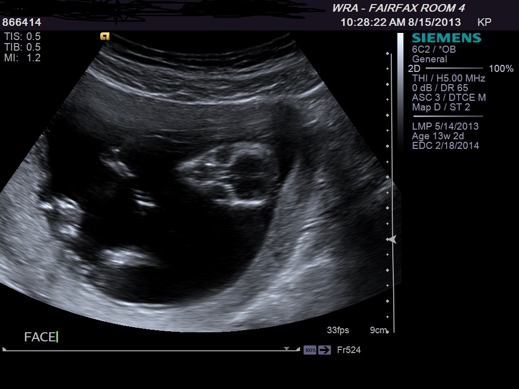 Name:  ultrasound 1 at 13 weeks.jpg
Views: 13082
Size:  153.8 KB