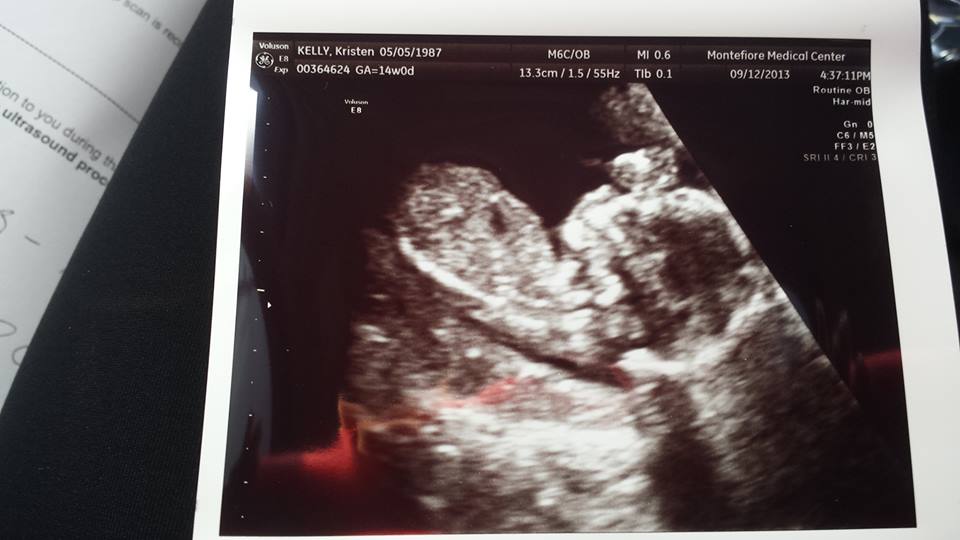 Name:  krisy fetal.jpg
Views: 1381
Size:  51.8 KB