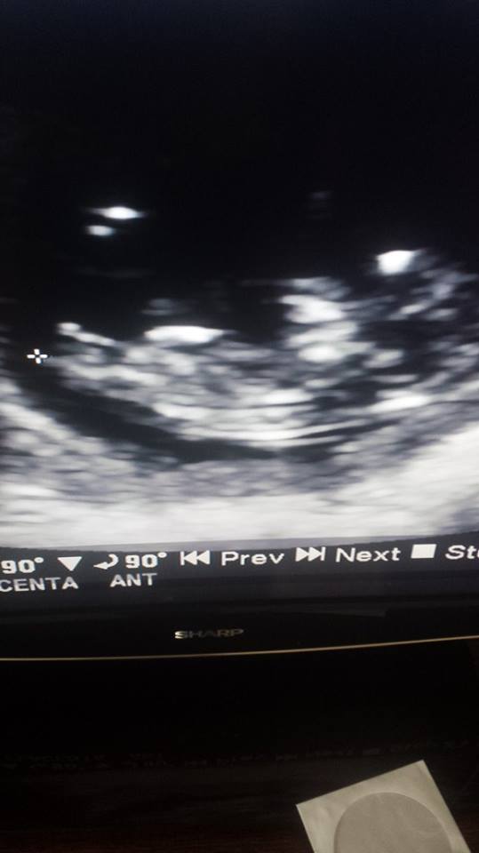 Name:  sarah ultrasound.jpg
Views: 305
Size:  32.4 KB