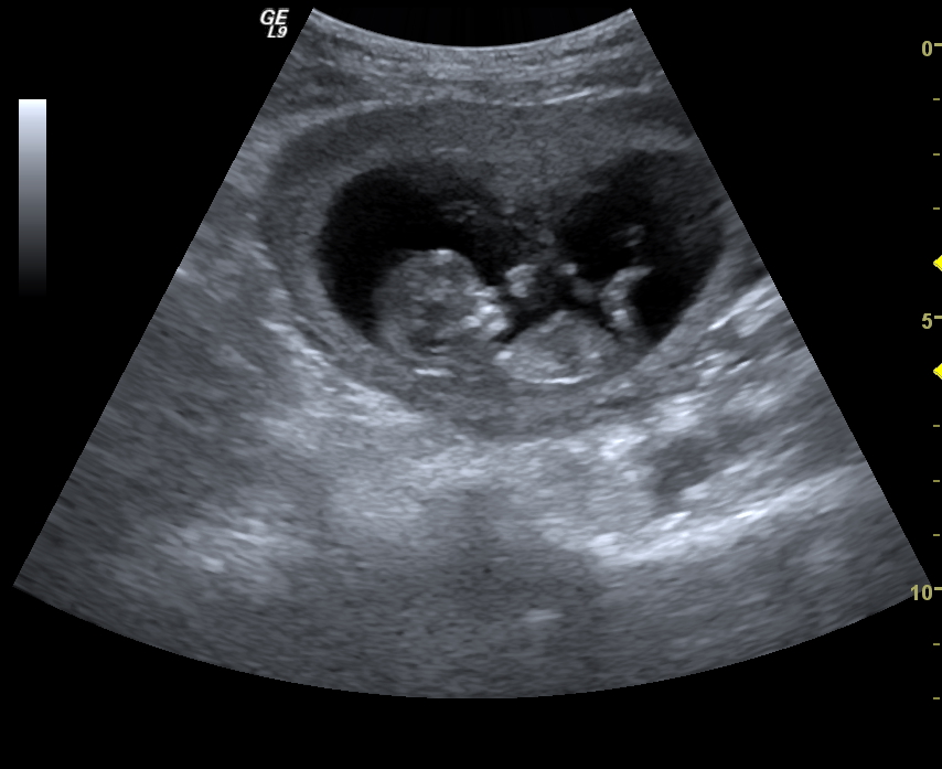 Name:  ultrasoundpics2013baby#2 001.jpg
Views: 119
Size:  238.3 KB