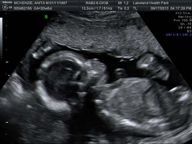 Name:  ultrasound #2 9-17-13 002.jpg
Views: 114
Size:  131.3 KB