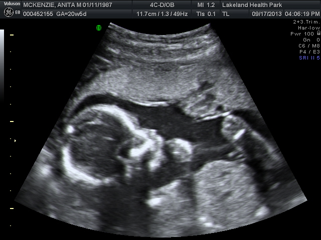 Name:  ultrasound #2 9-17-13 001.jpg
Views: 111
Size:  131.5 KB