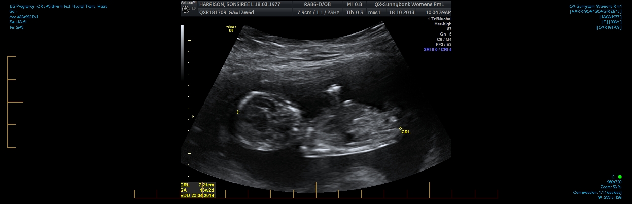 Name:  US Pregnancy -CRL 45-84mm incl. Nuchal Trans. Meas 0001.jpg
Views: 224
Size:  163.7 KB