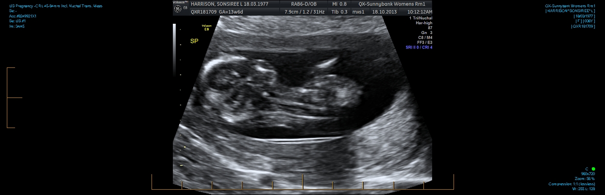 Name:  US Pregnancy -CRL 45-84mm incl. Nuchal Trans. Meas 0003.jpg
Views: 247
Size:  184.7 KB