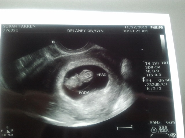 Name:  baby 9weeks 1 day transvaginal.jpg
Views: 215
Size:  73.7 KB
