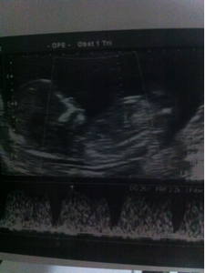 Name:  Baby 12 week scan 2nd.jpg
Views: 294
Size:  69.8 KB