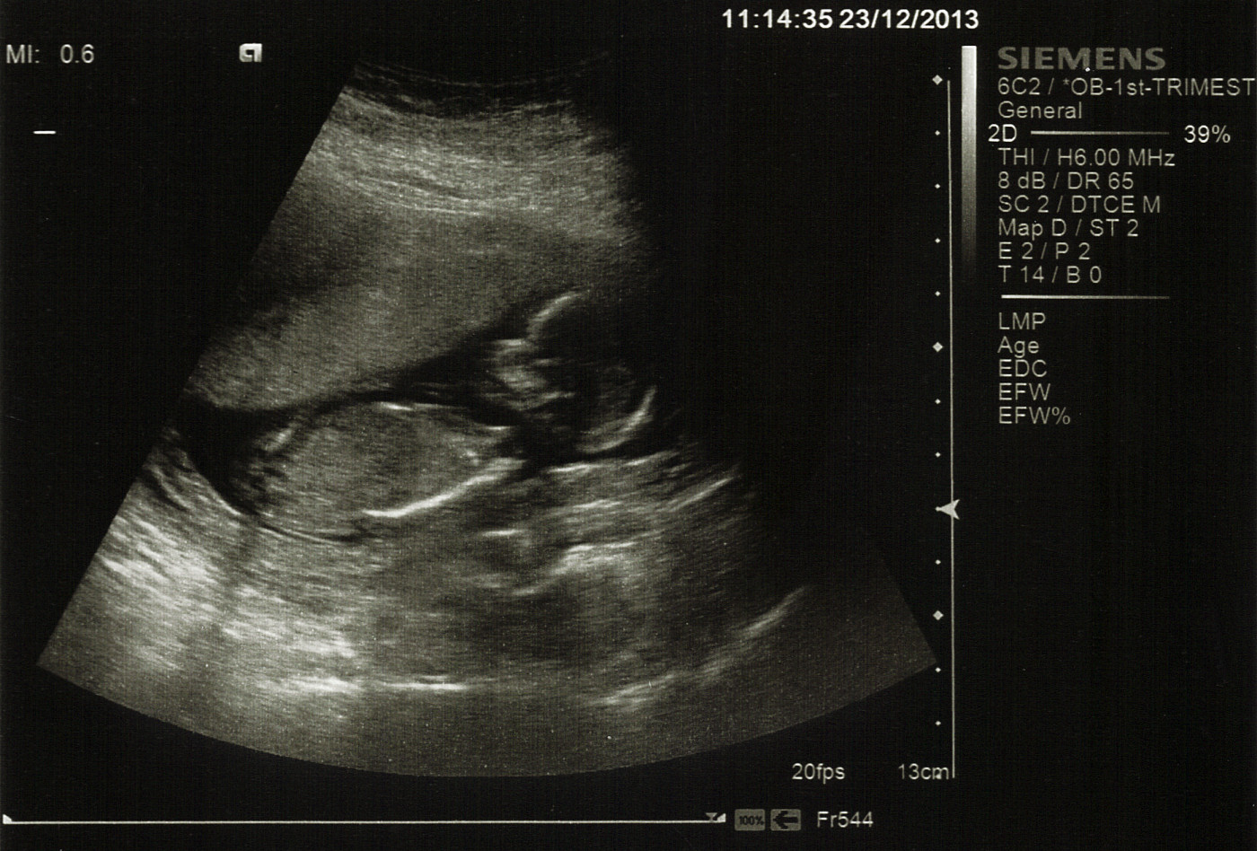 Name:  2013-12-23 13 Week Scan picture2_corrected_anon.jpg
Views: 170
Size:  378.8 KB