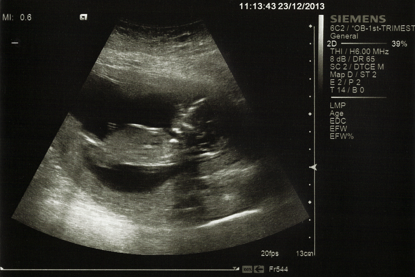 Name:  2013-12-23 13 Week Scan picture1_corrected_anon.jpg
Views: 152
Size:  383.7 KB