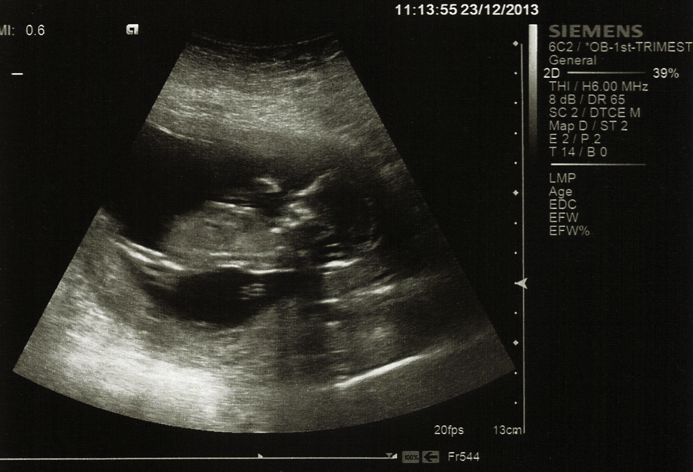 Name:  2013-12-23 13 Week Scan picture3_corrected_anon.jpg
Views: 164
Size:  335.7 KB