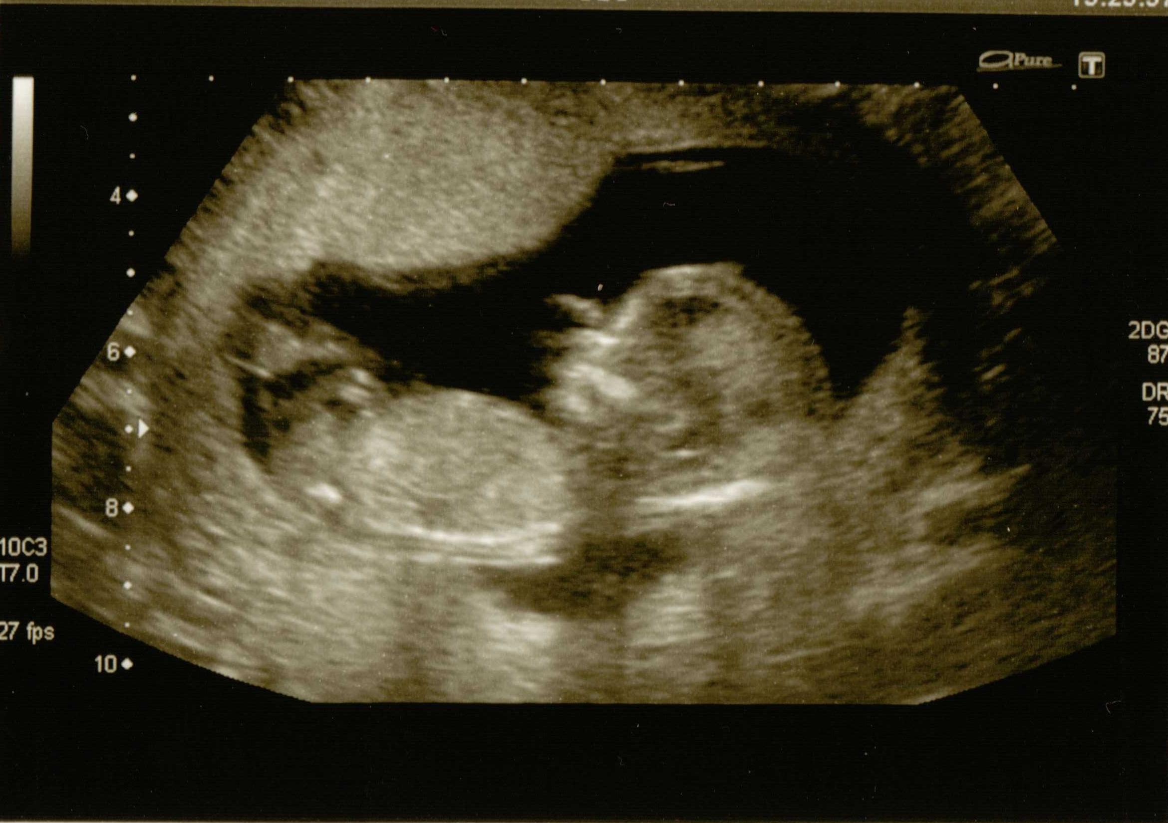 Name:  baby scan.jpg
Views: 195
Size:  286.1 KB