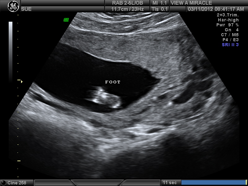 Name:  Adriana 16 weeks 002.jpg
Views: 3000
Size:  157.2 KB