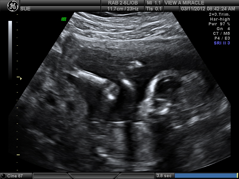 Name:  Adriana 16 weeks 005.jpg
Views: 1016
Size:  159.6 KB