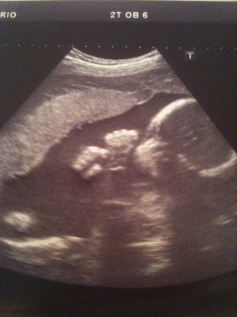 Name:  Baby Rooney Scan.jpg
Views: 186
Size:  119.5 KB