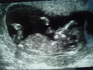 Name:  baby 12w 4days.jpg
Views: 392
Size:  14.2 KB