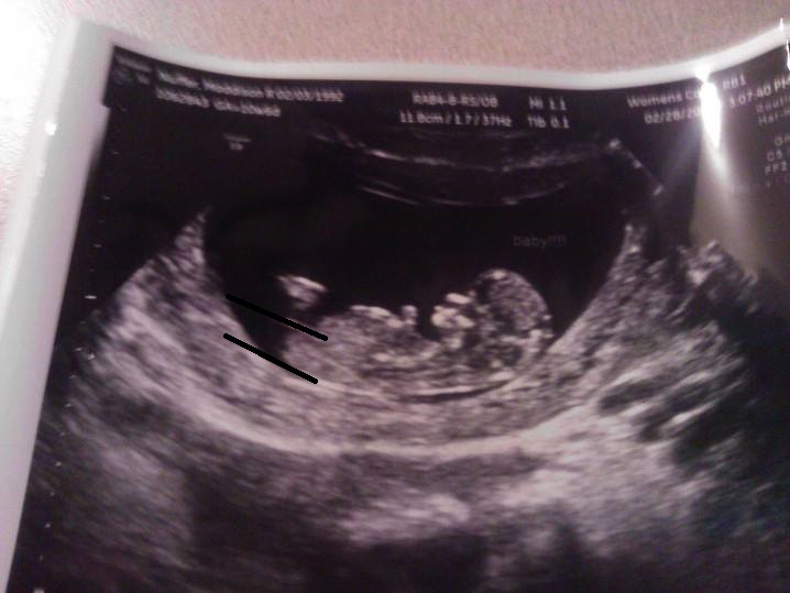 Name:  baby with lines.jpg
Views: 95
Size:  73.2 KB