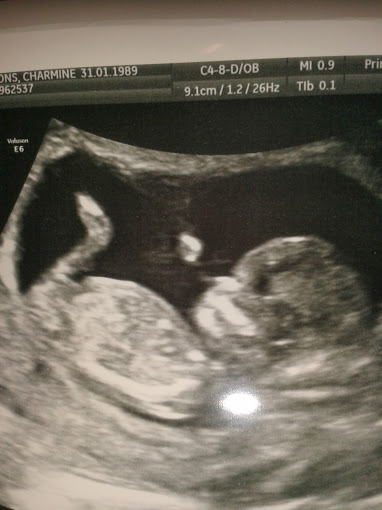 Name:  Scan 12 wks 3 days 2nd pic.jpg
Views: 288
Size:  36.3 KB