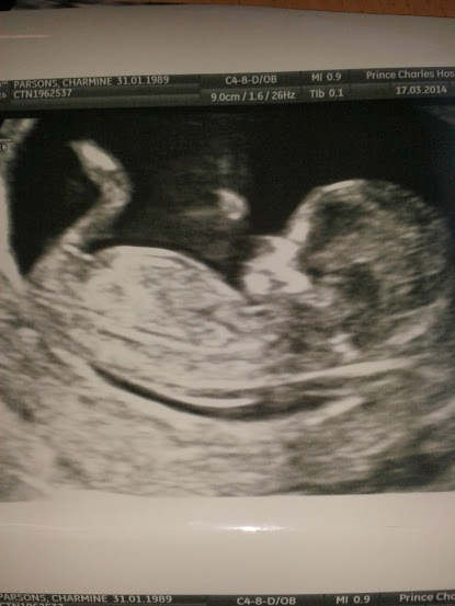 Name:  Scan 12 wks 3 days.jpg
Views: 285
Size:  38.0 KB