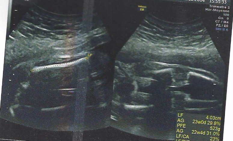 Name:  femur pic.jpg
Views: 287
Size:  103.0 KB