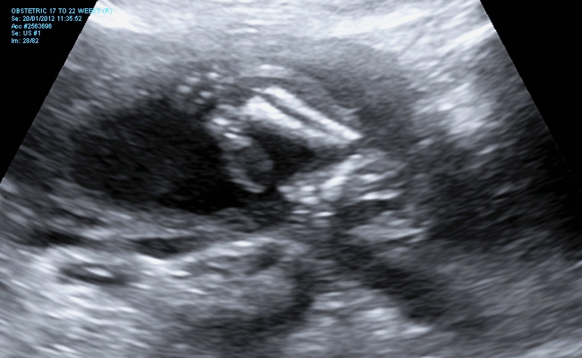Name:  Legs 19 weeks.jpg
Views: 188
Size:  262.9 KB