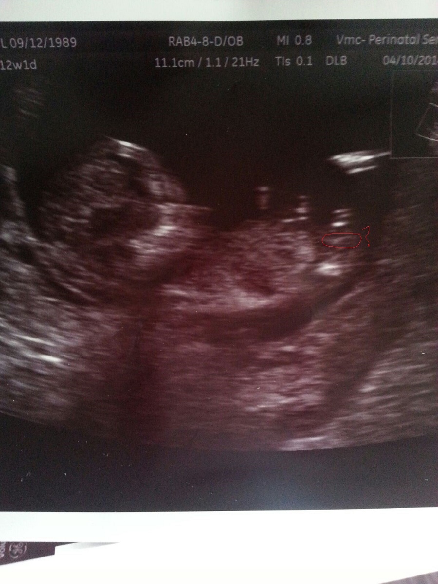 Name:  baby ultrasound1.jpg
Views: 379
Size:  285.6 KB