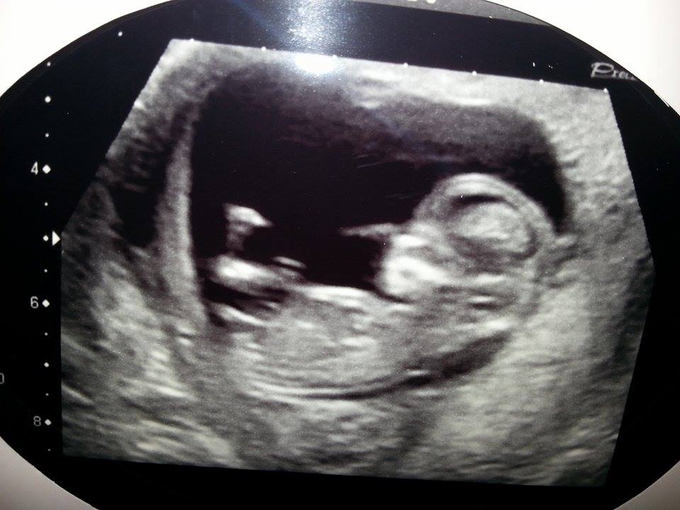 Name:  baby number 2 scan.jpg
Views: 210
Size:  70.1 KB
