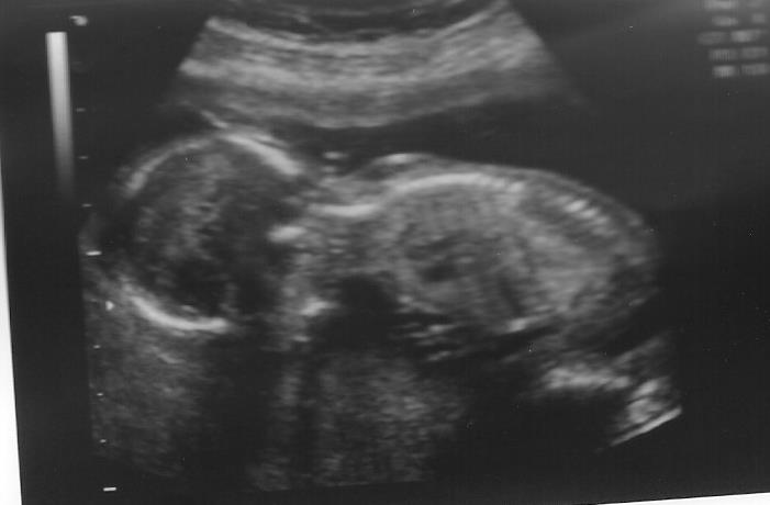 Name:  16w baby #4.jpg
Views: 134
Size:  22.6 KB