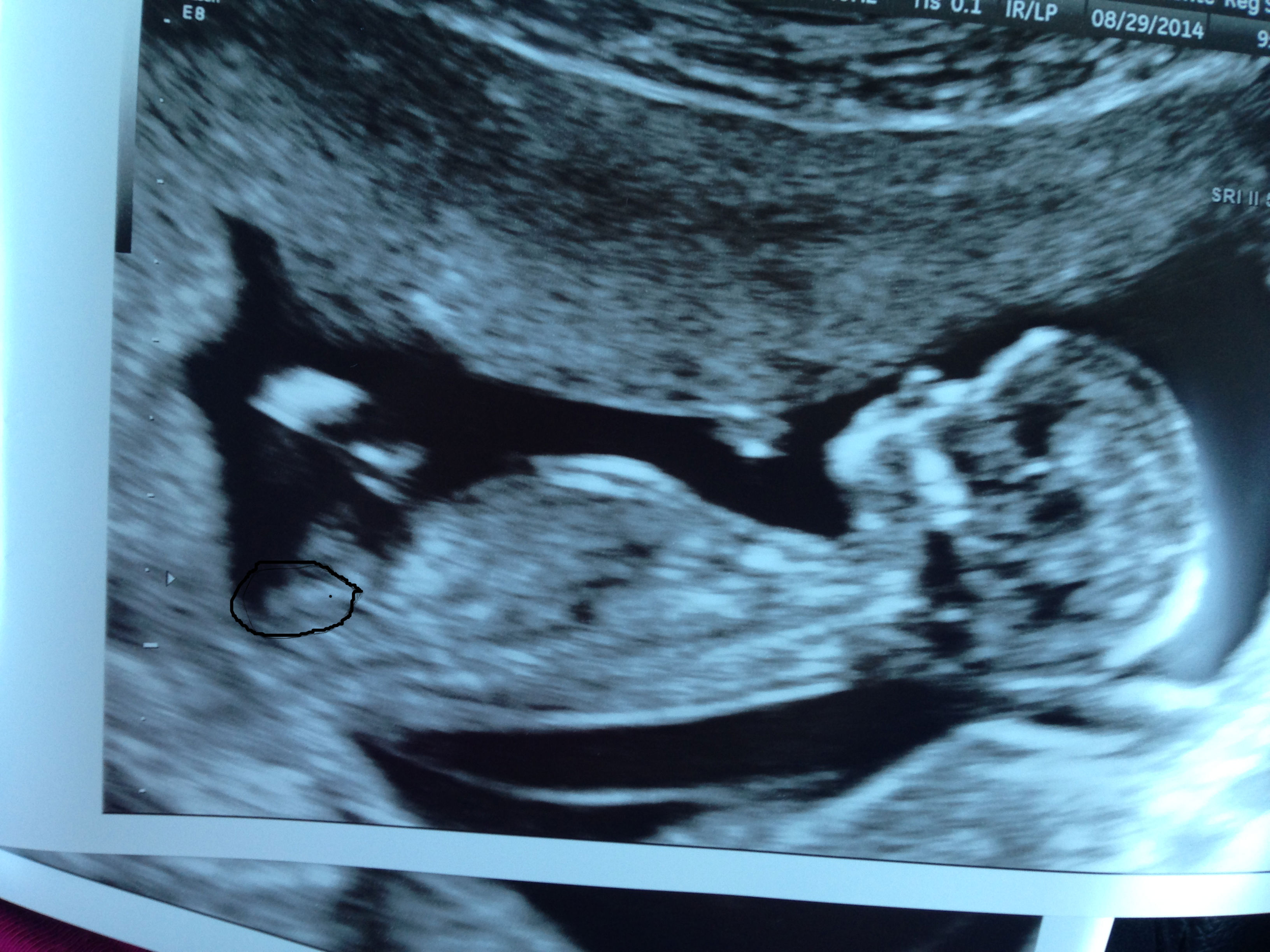 Name:  baby 12w 3 d.jpg
Views: 83
Size:  868.8 KB