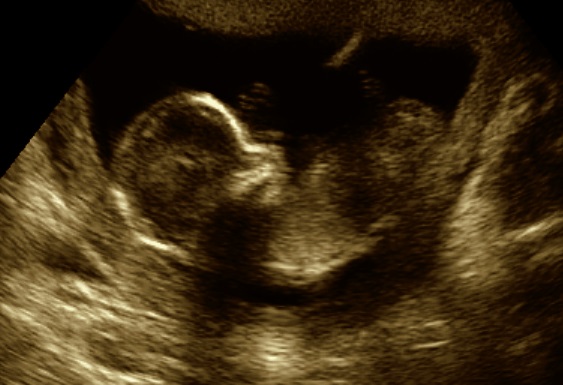 Name:  ultrasound 3.jpg
Views: 193
Size:  61.0 KB