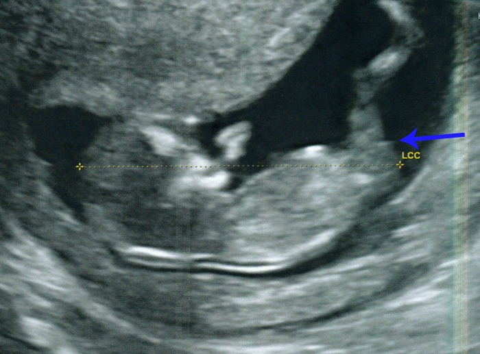 Name:  Baby Wright 12 Weeks 1 Day  - NUB Confusion.jpg
Views: 973
Size:  109.9 KB