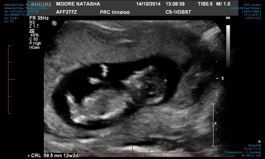 Name:  INNA-NUCHAL TRANSLUCENCY 0003.jpg
Views: 184
Size:  196.8 KB