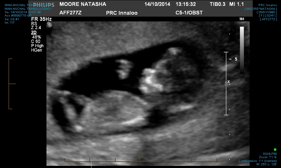 Name:  INNA-NUCHAL TRANSLUCENCY 0001.jpg
Views: 454
Size:  180.2 KB