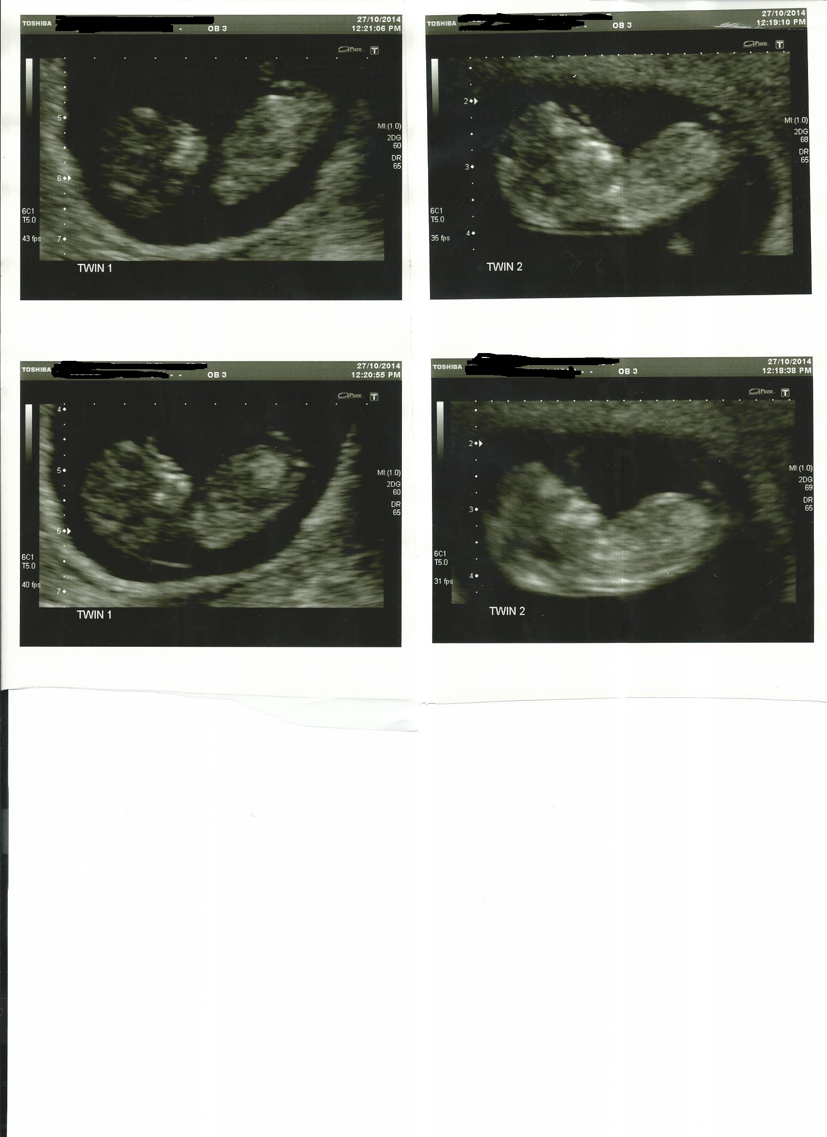 Name:  twin 1 and 2 at  11 week 2 days - new.jpg
Views: 5022
Size:  371.5 KB