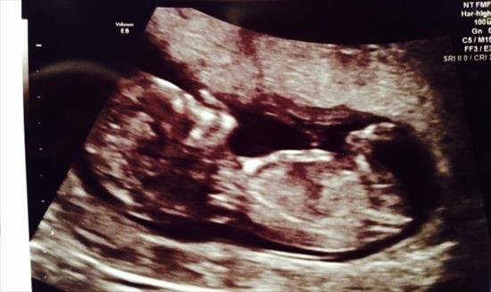 Name:  12 week ultrasound shot.jpg
Views: 1142
Size:  27.7 KB