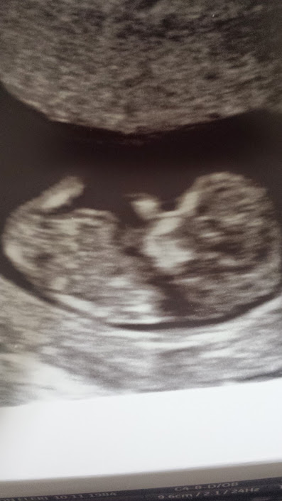 Name:  Scan at 11 weeks 3 days.jpg
Views: 5902
Size:  48.6 KB