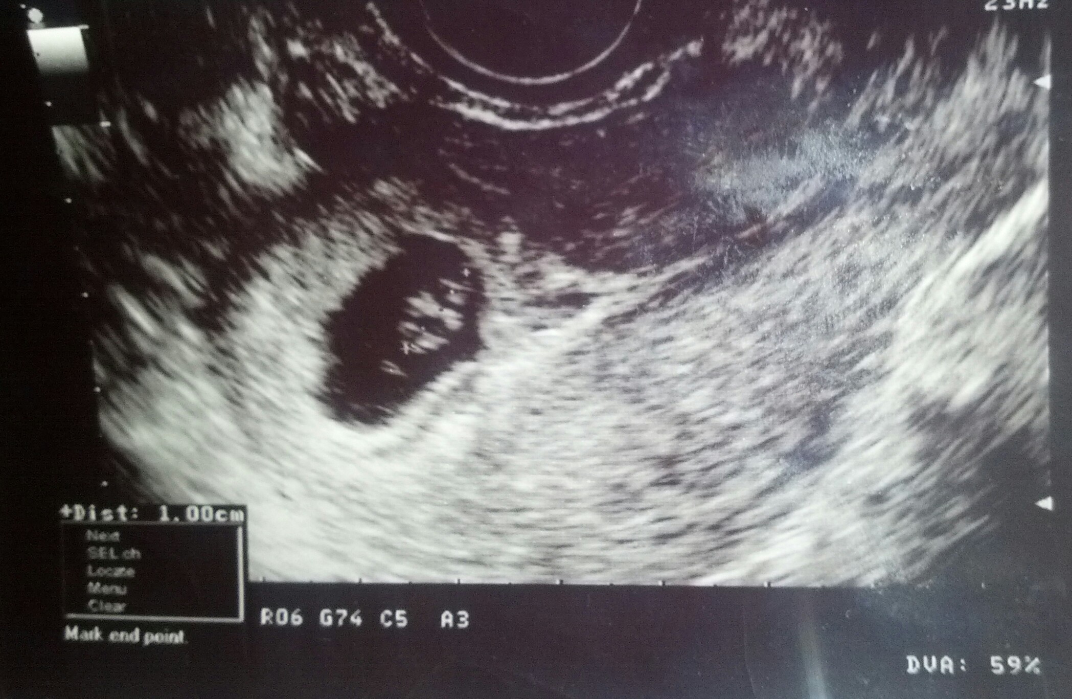 Name:  7 weeks 3 days Sagital ultrasound.jpg
Views: 1519
Size:  553.4 KB