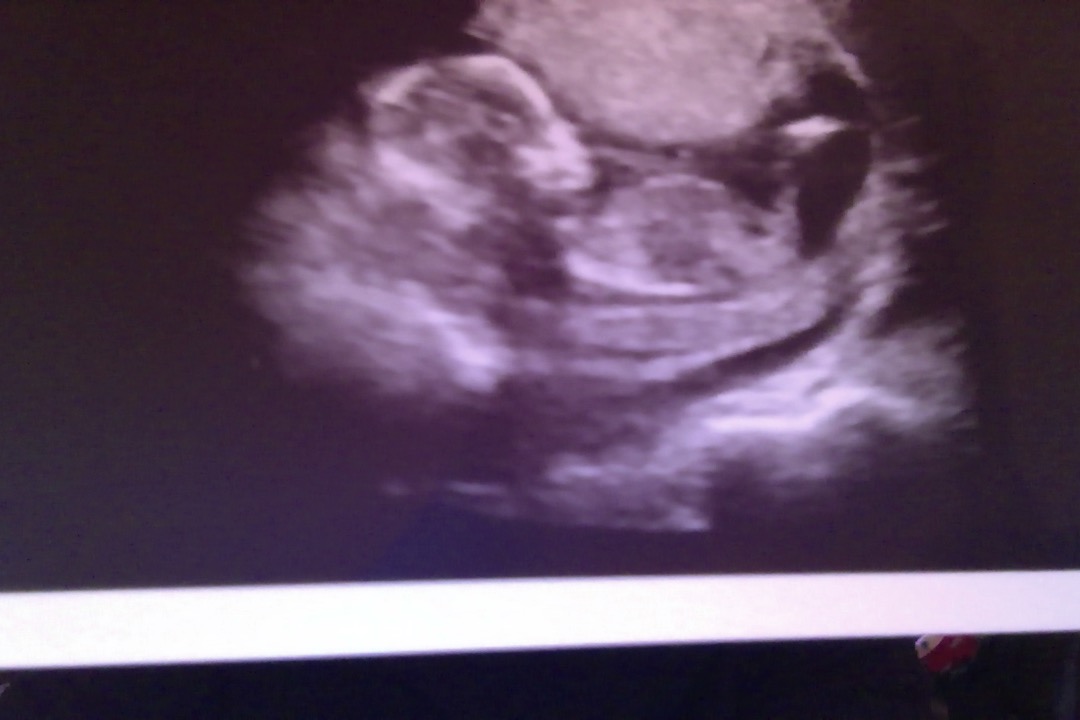 Name:  ultrasound-13w4d.jpg
Views: 658
Size:  94.8 KB