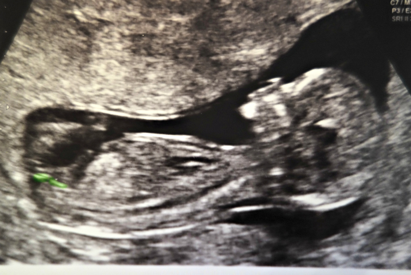 Name:  12 Week 5 days Nub Shot Guess (2)-001.JPG
Views: 260
Size:  291.4 KB