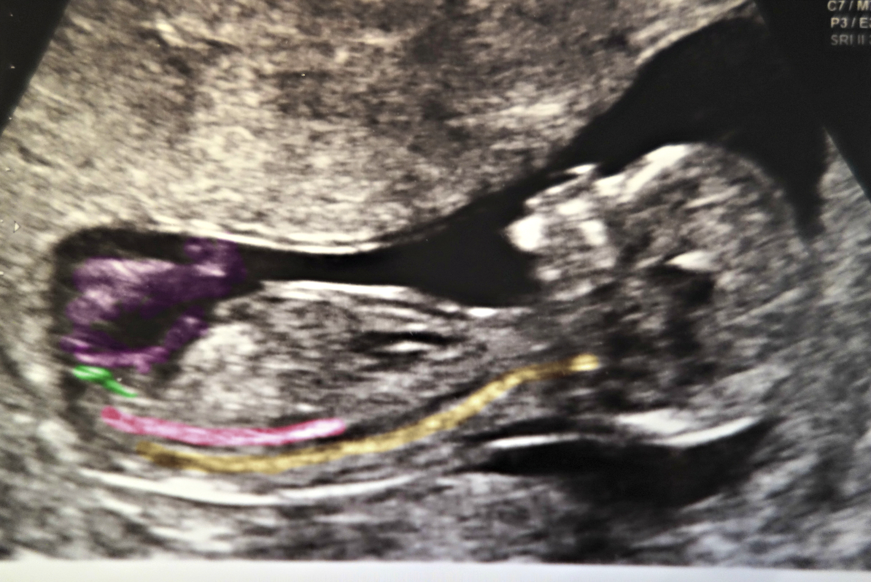 Name:  12 Week 5 days Nub Shot Guess (2)-001.JPG
Views: 661
Size:  2.76 MB