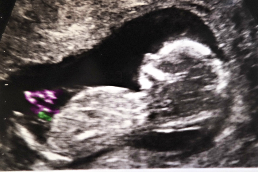 Name:  12 Week 5 days Nub Shot Guess (3)-001.JPG
Views: 407
Size:  271.8 KB
