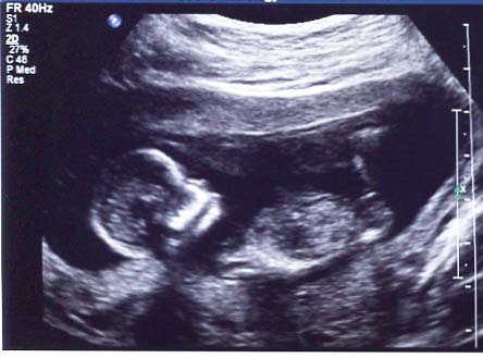 Name:  20150205-20150205-Baby 2 Scan 12w6d - 1.jpg
Views: 1978
Size:  66.2 KB