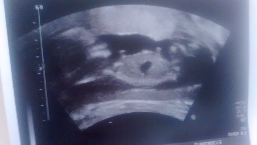 Name:  ultrasound 13w6d sized.jpg
Views: 239
Size:  153.5 KB