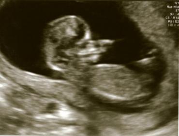 Name:  Ultrasound12weeks_4P.jpg
Views: 522
Size:  13.2 KB