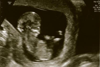 Name:  Ultrasound12weeks_3P.jpg
Views: 519
Size:  14.8 KB