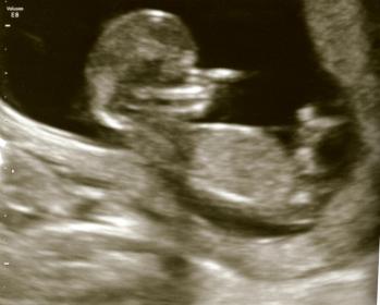Name:  Ultrasound12weeks_2P.jpg
Views: 322
Size:  12.8 KB